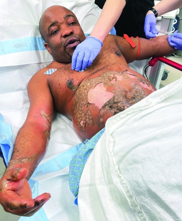 Minister Richard Inyang receives treatment for grease burns at a Minnesota hospital.